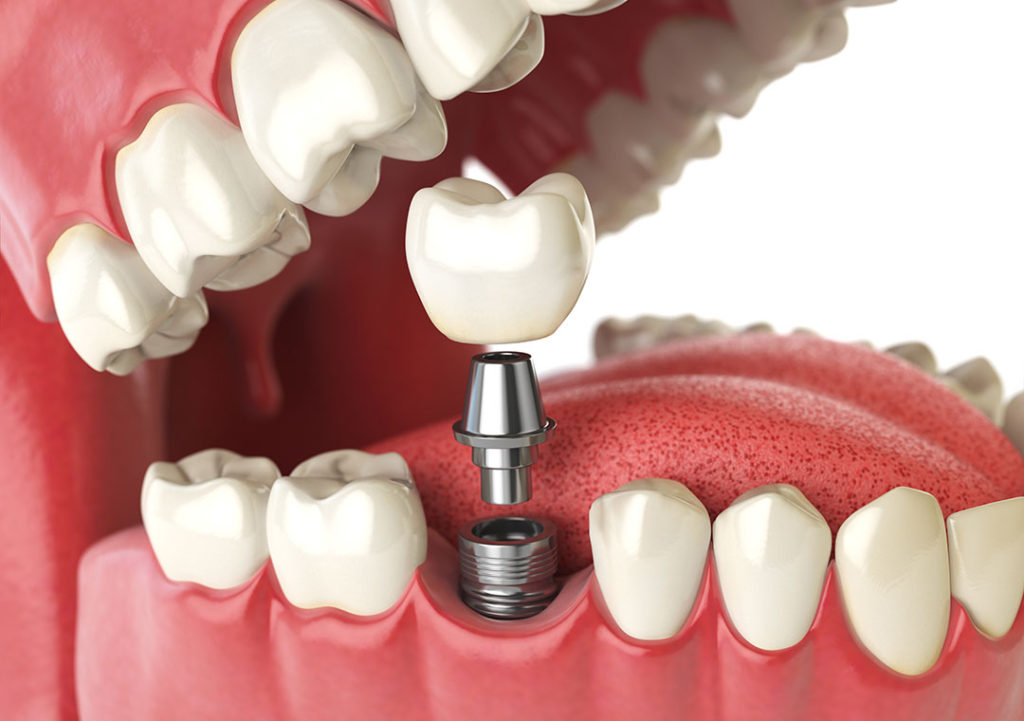 dental-implants-1024x721